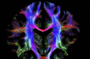 B0010280 Healthy human brain from a young adult, tractography Credit: Alfred Anwander, MPI-CBS. Wellcome Images images@wellcome.ac.uk http://wellcomeimages.org Coronal view of nerve fibres in the brain of a young healthy adult, which has been virtually sliced down a vertical axis to divide it into front and back. The brain is viewed from behind, with the left side of the brain on the left of the image. This image was created by virtually dissecting the brain using data obtained from diffusion magnetic resonance imaging (MRI). Diffusion weighted imaging is a specialised type of MRI scan which measures water diffusion in many directions in order to reconstruct the orientation of bundles of nerve fibres. Tractography is used to indirectly model these nerve fibres, which transmit information between different regions of the brain. These have been colour-coded to help distinguish between different tracts which pass close to each other. For example, fibres connecting the left and right hemispheres (red), fibres travelling from top to bottom (blue) connecting to the spinal cord, and fibres running from front to back (green) are visible here. Reconstructing these connections between different parts of the brain will aid our understanding of how the brain functions in health and disease, and could ultimately become a tool in the same way as the human genome. Width of image is approximately 165 mm. Magnetic resonance imaging 2015 Published: - Copyrighted work available under Creative Commons by-nc-nd 4.0, see http://wellcomeimages.org/indexplus/page/Prices.html